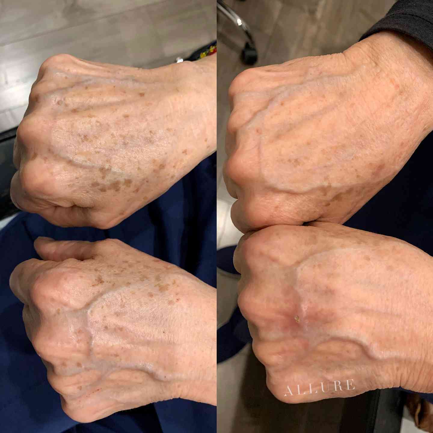 Dark Spot Removal