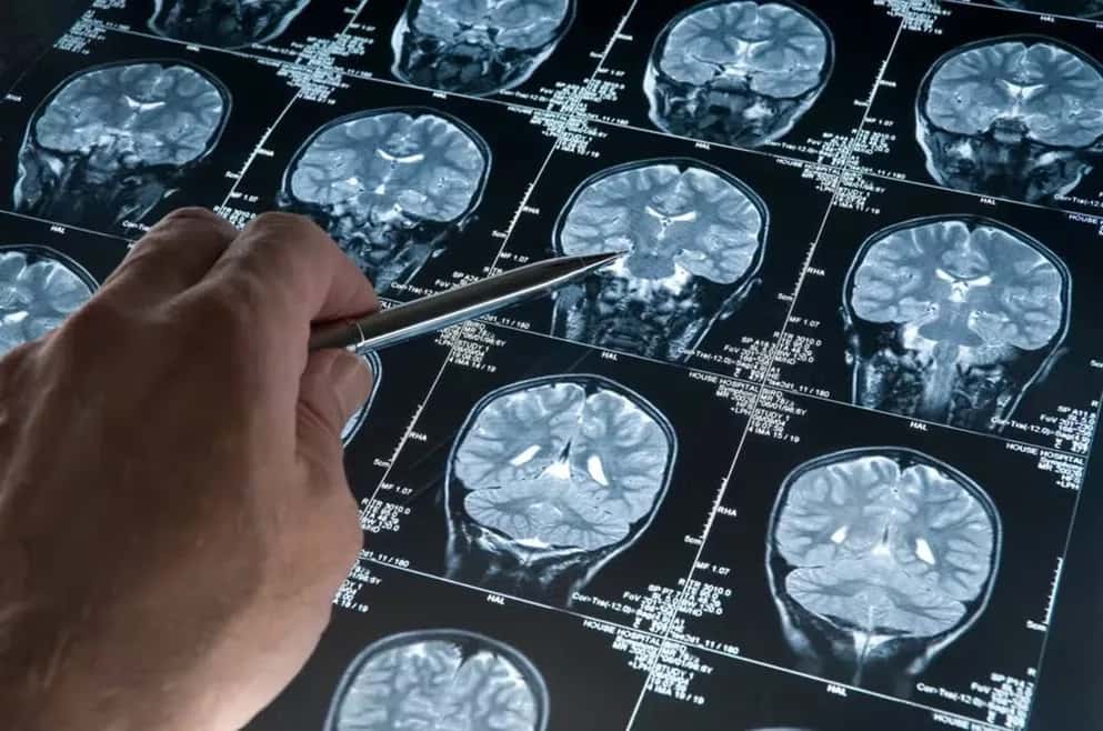 ALZHEIMER’S PREVENTION 101